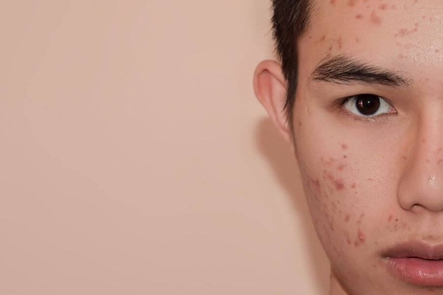 Skin Problem Acne