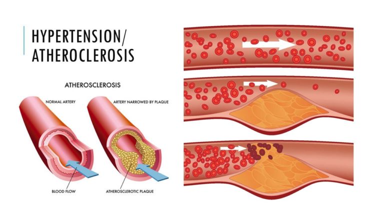 how-does-high-blood-pressure-affect-atherosclerosis-liv-healthy-life