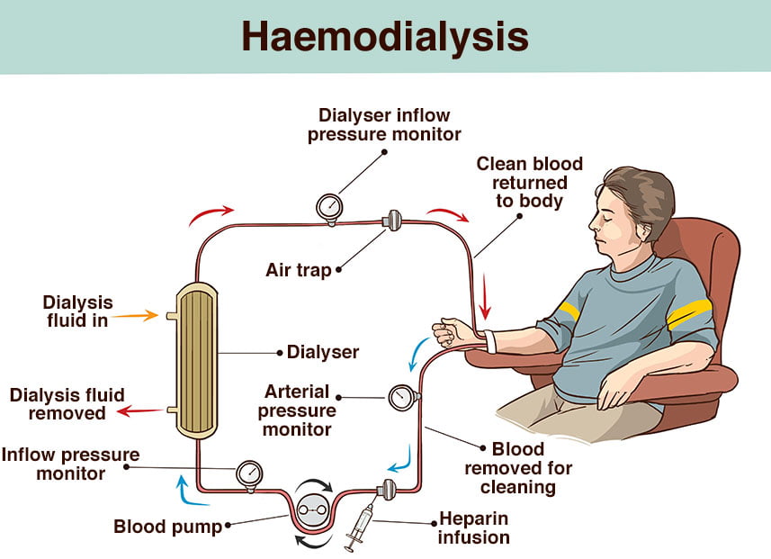 This image has an empty alt attribute; its file name is haemodialysis-illustration-c8ce3b.jpg
