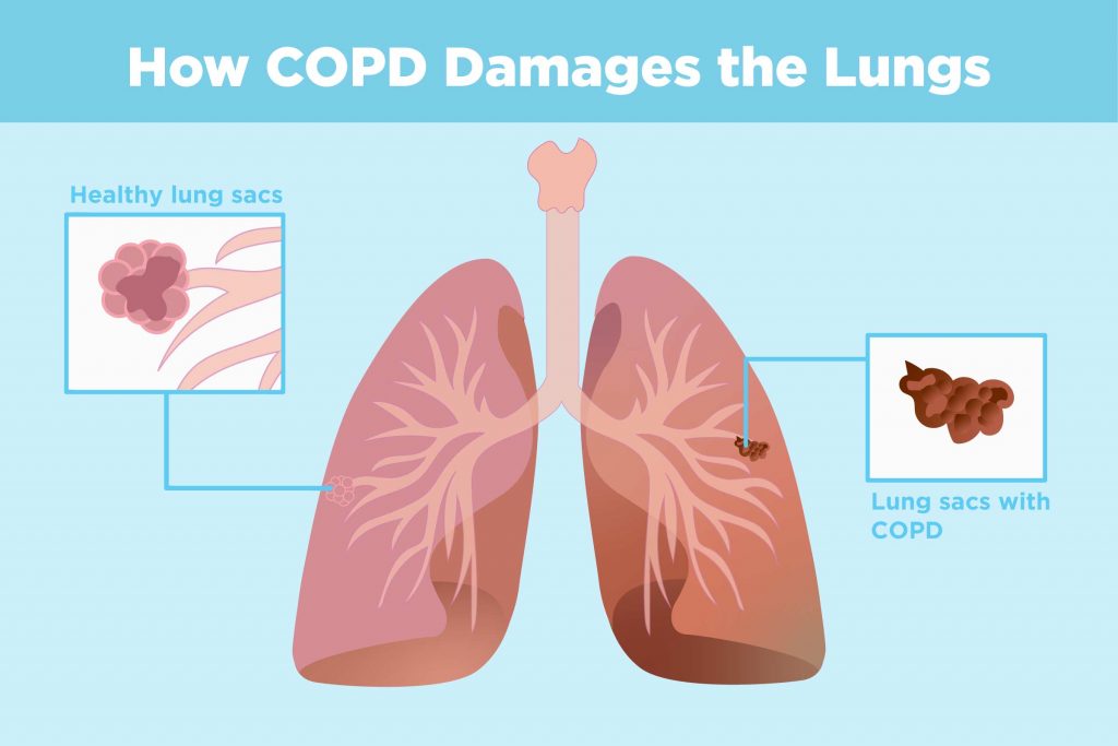 difference between healthy lung sac and COPD lung sac 