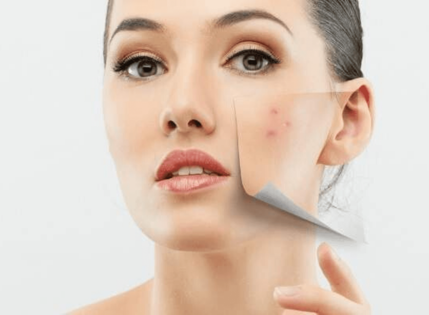 acne- causes ,types
