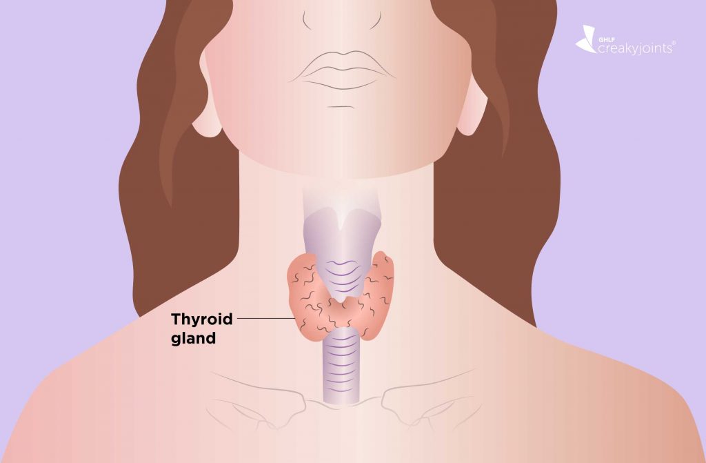hypothyroidism 