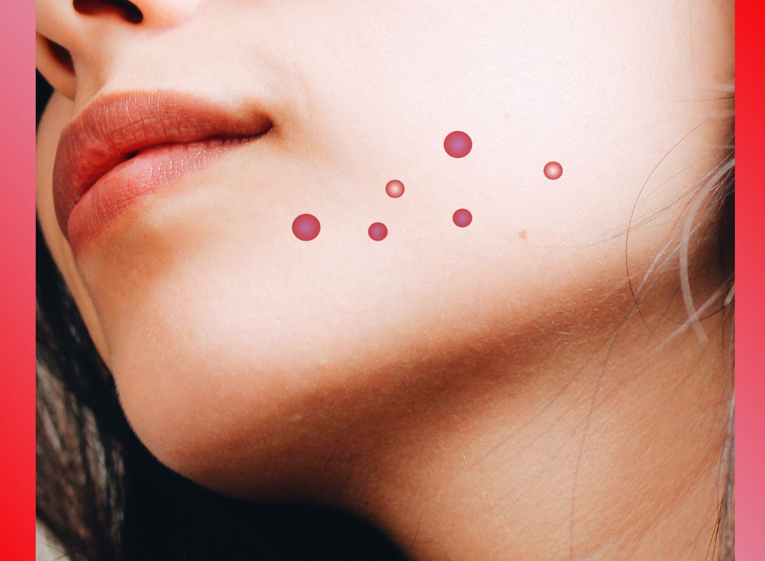 myths about acne
