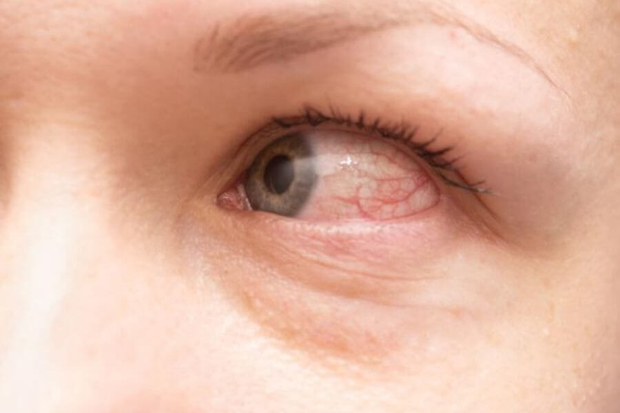 Conjunctivitis