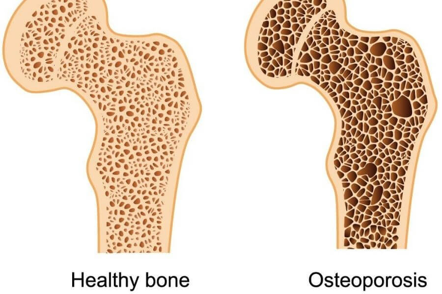 Osteoporosis