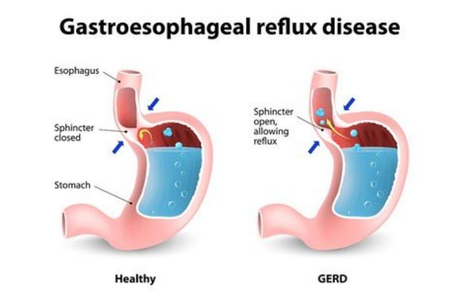 Gastroesophageal Reflux Disease