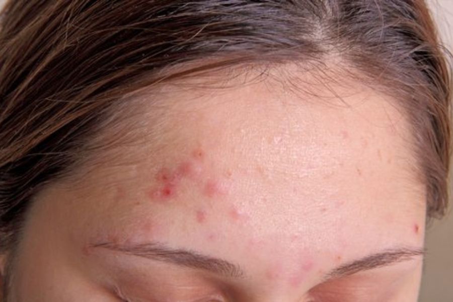 Acne Vulgaris