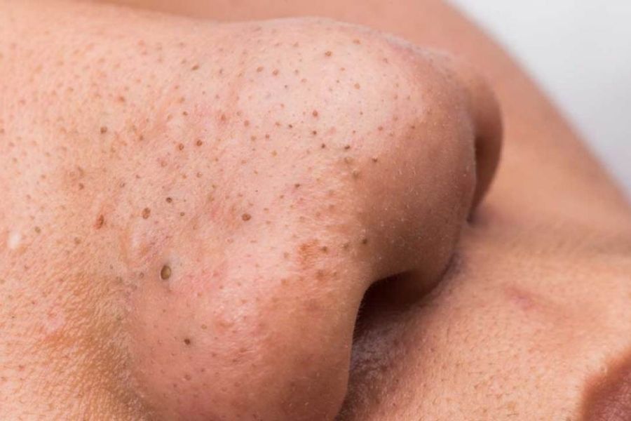 Blackheads 