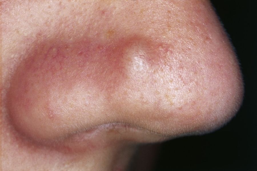 Papules 