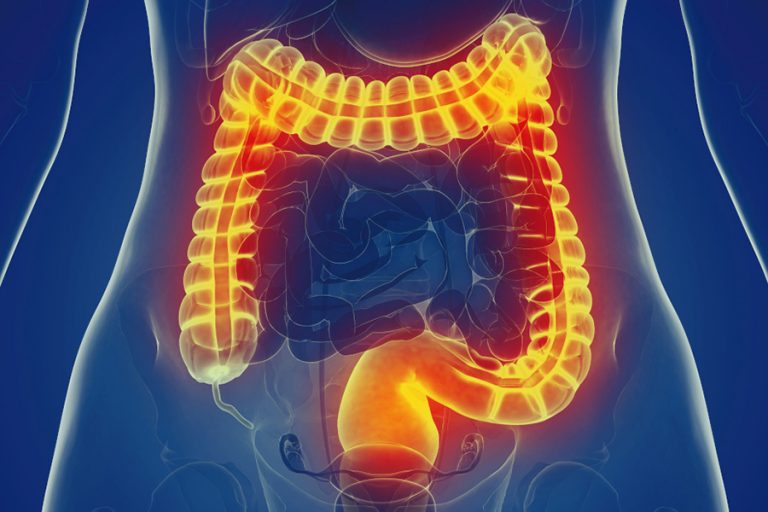 What Is Irritable Bowel Syndrome (IBS)? - Liv Healthy Life