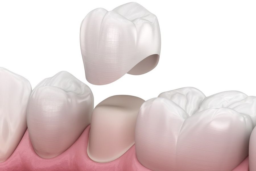 Dental Crowns