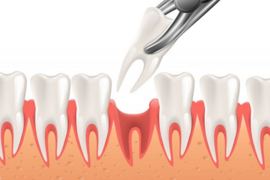 Tooth Extractions