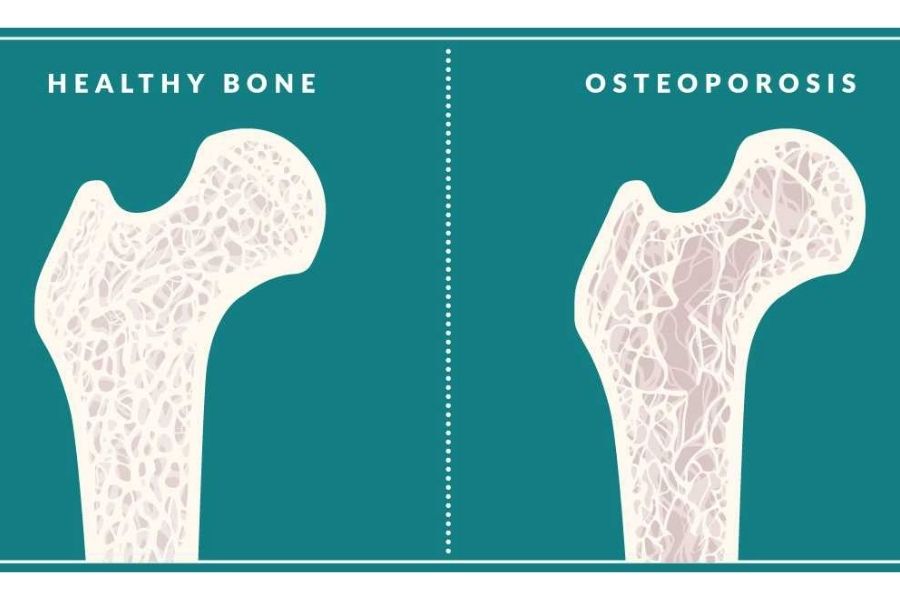 Osteoporosis