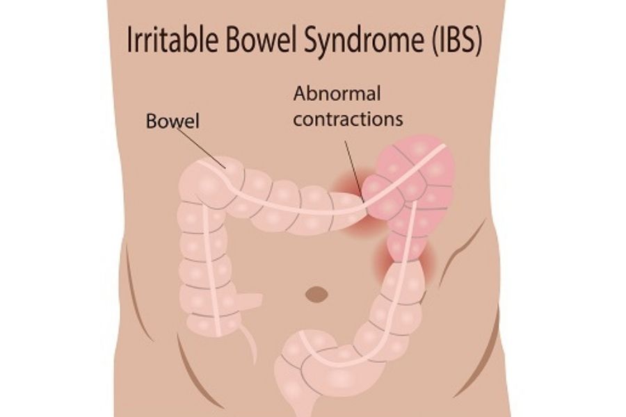 Irritable Bowel Syndrome