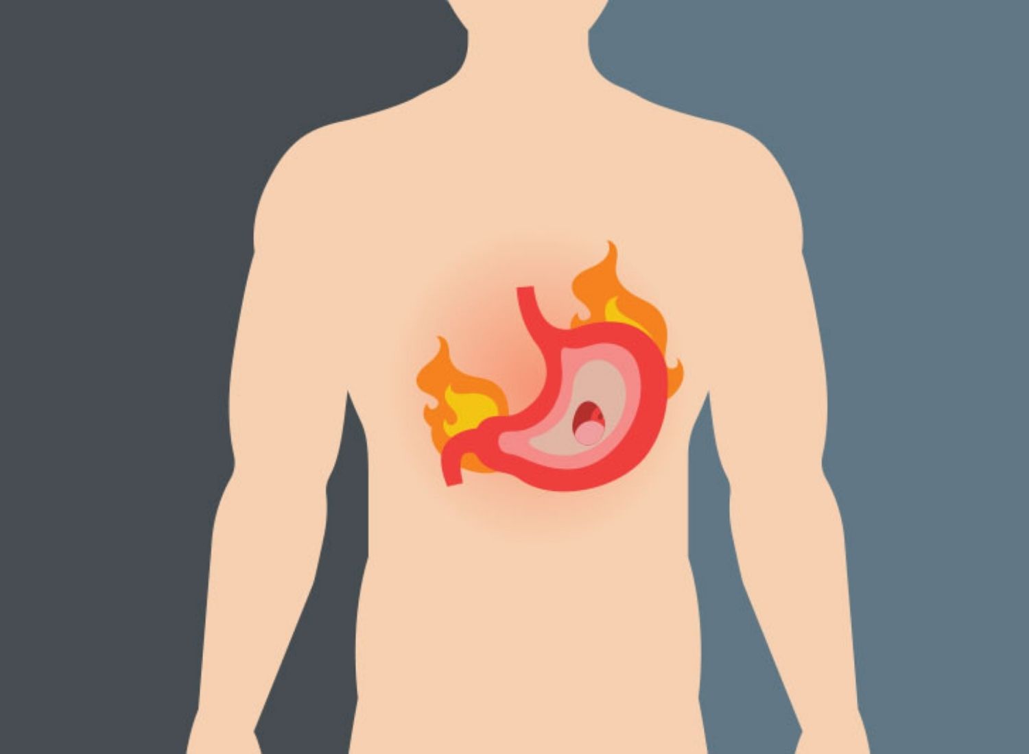 Gastritis: Types, Causes, Impact, Medication, Nutrition