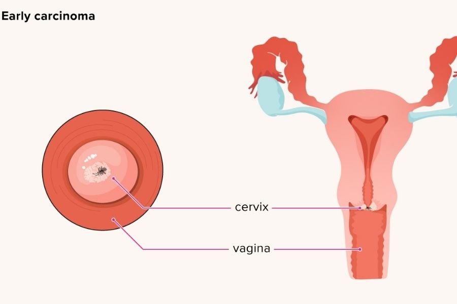 Risk Factors Of Cervical Cancer