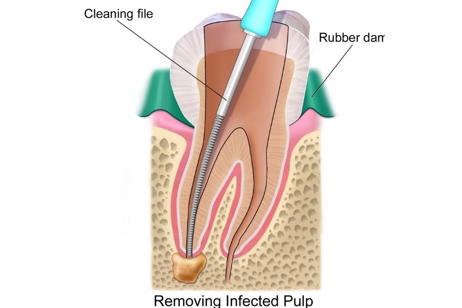 Root Canals