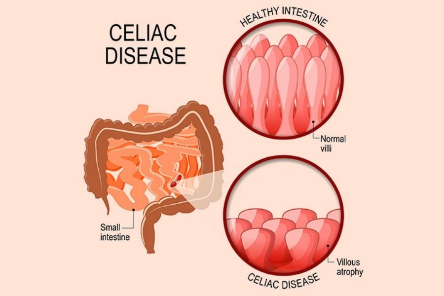 Celiac Disease