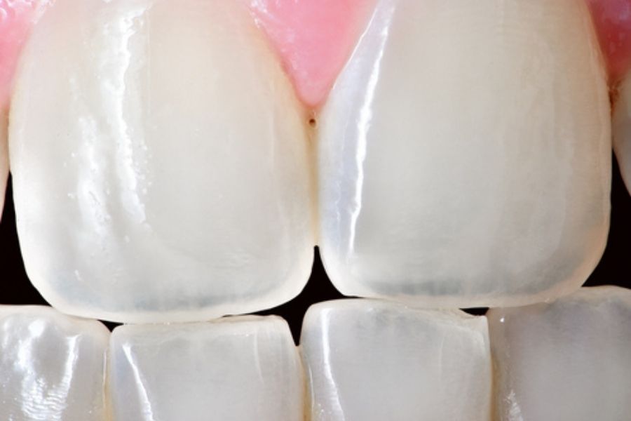 tooth erosion