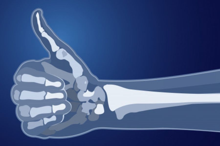 Bone loss. Здоровые кости. Прочные кости. Крепкие кости. Рентген руки.